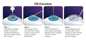 prk laser eye surgery procedure