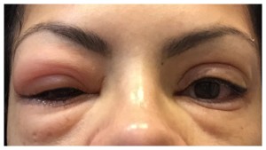 infection in eyes due to false eyelashes