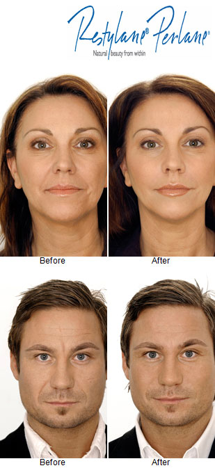 dermal-fillers-before-and-after-1