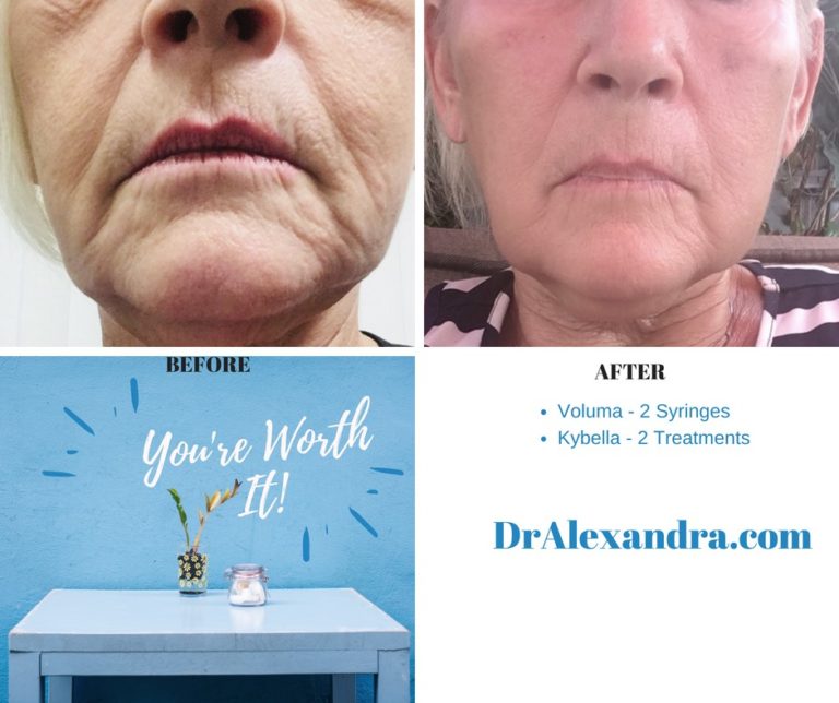 Kybella Vs Liposuction Orange County Lasik Center Medical Group