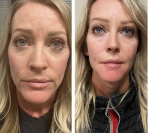 Botox® treatment at Lasik Center Medical Group in Newport Beach