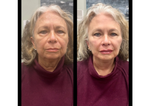 Botox® Cosmetic for frown lines and crow's feet