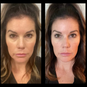 Botox® results at Lasik Center Medical Group